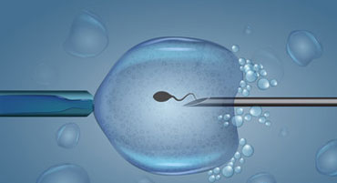 ICSI-IVF