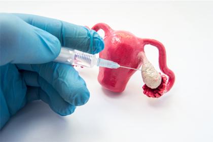 Ovulation-Induction